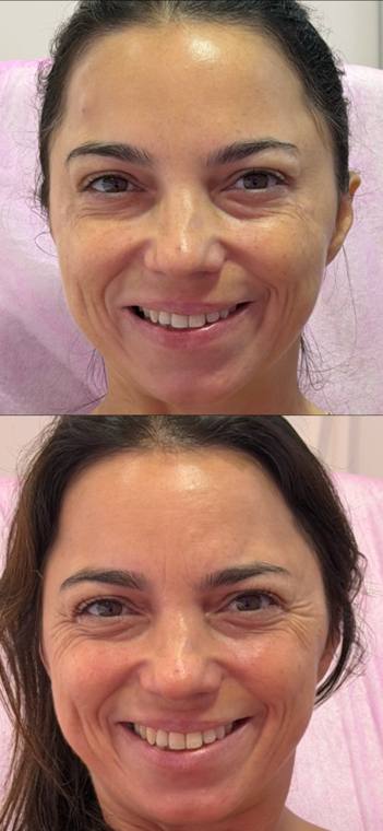 Antes e depois de harmonização facial