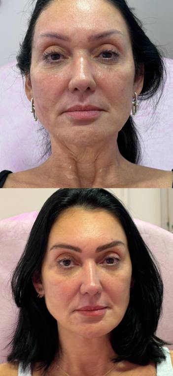 Antes e depois de harmonização facial