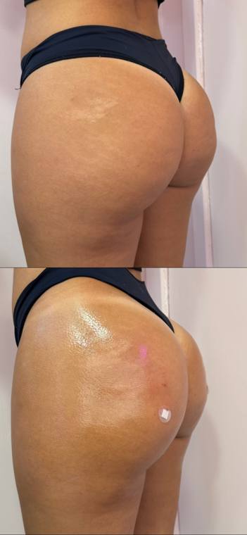 Antes e depois de harmonização glútea