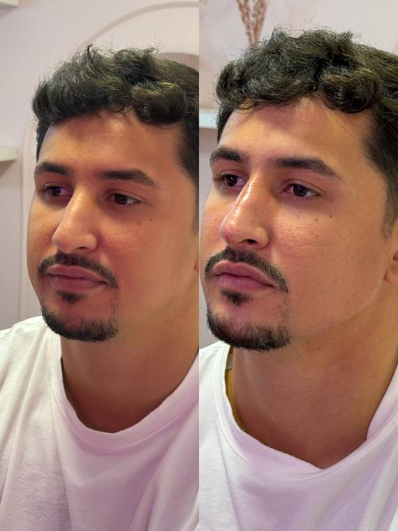 Antes e depois de harmonização facial