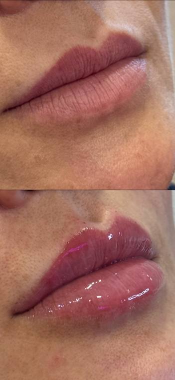 Antes e depois de preenchimento labial