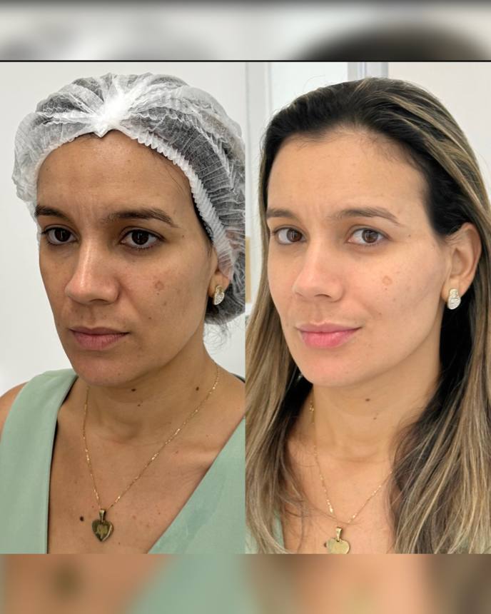 Antes e depois — qualidade de pele