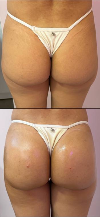Antes e depois de harmonização glútea