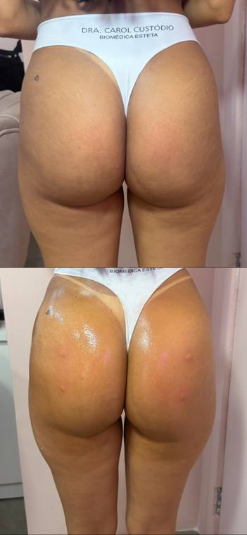 Antes e depois de harmonização glútea