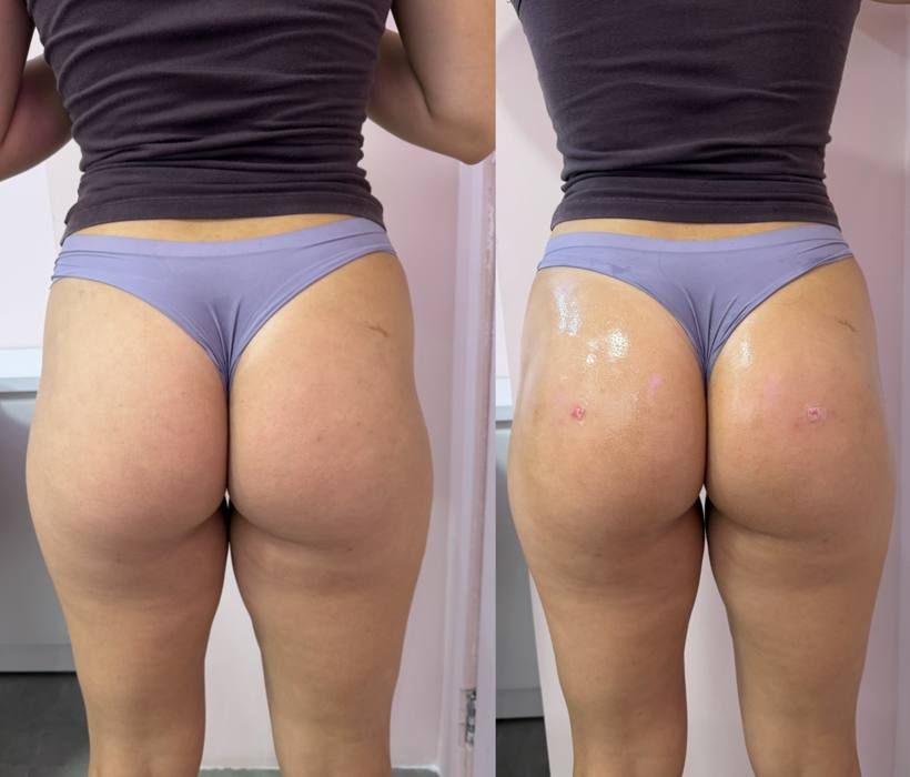 Antes e depois de harmonização glútea