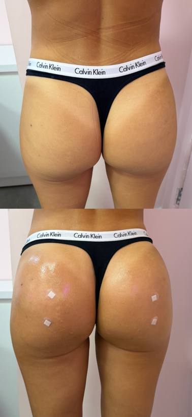 Antes e depois de harmonização glútea