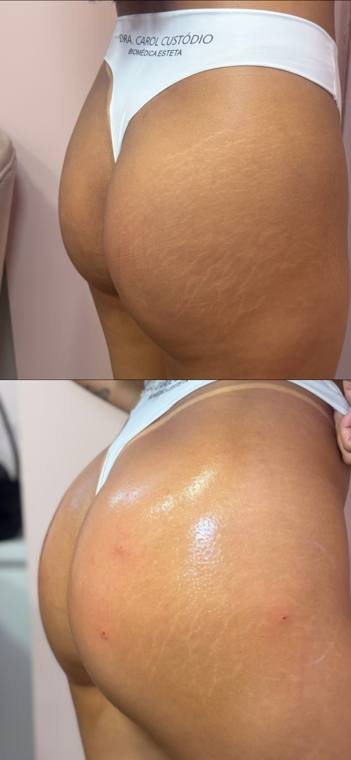 Antes e depois de harmonização glútea