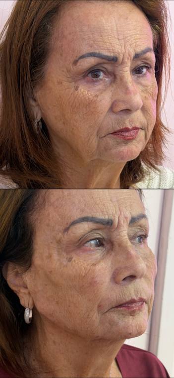 Antes e depois de harmonização facial