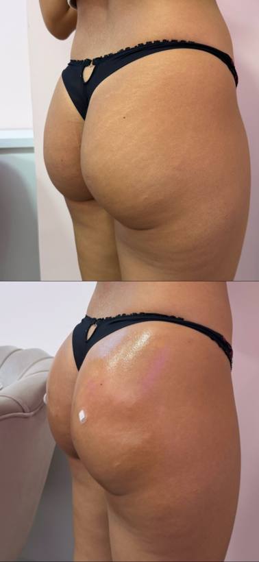 Antes e depois de harmonização glútea