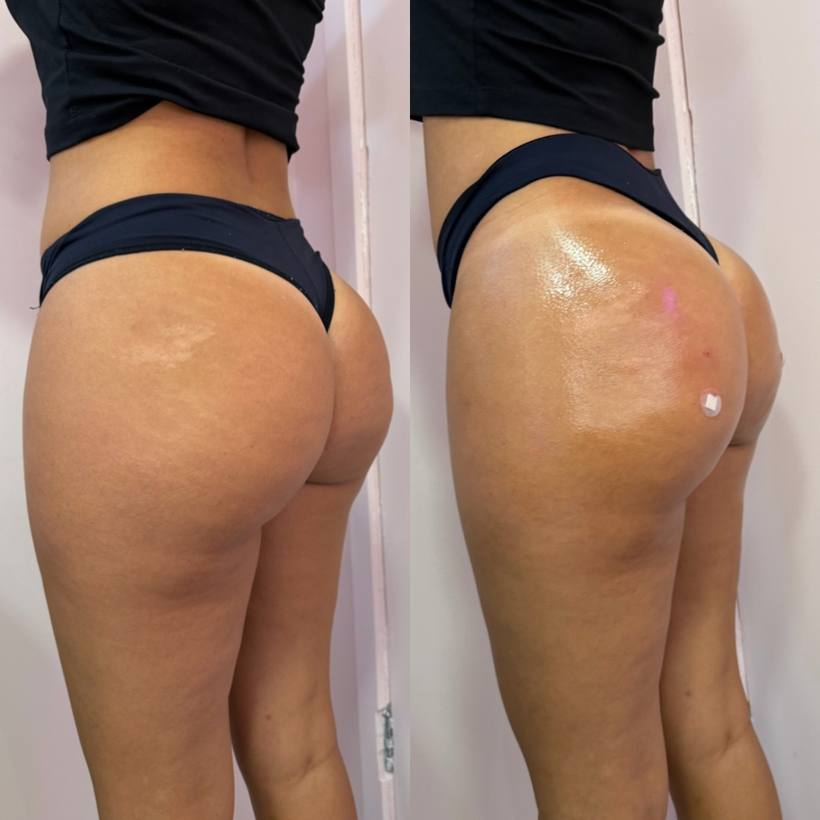 Antes e depois de harmonização glútea