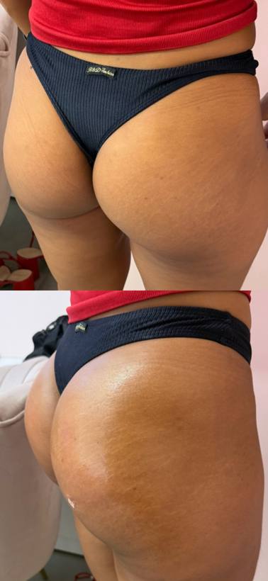 Antes e depois de harmonização glútea